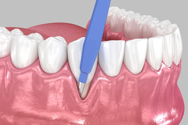 Types Of Dental Bone Grafts